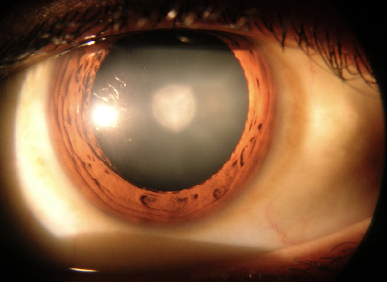 normal vision